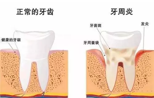 正常的牙齿和牙周炎对比