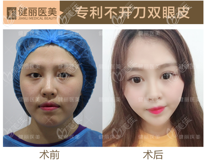 我去广州健丽做了不开刀双眼皮