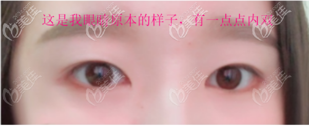 这是我做全切双眼皮术前的样子 这是我做全切双眼皮术前的样子
