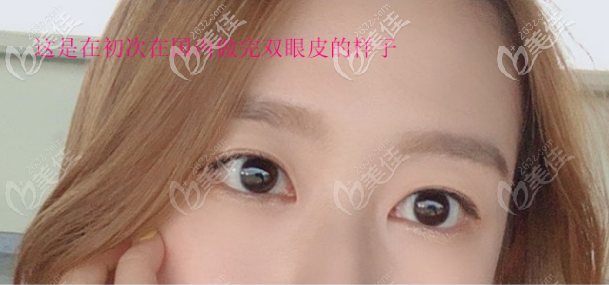 这是我在国内做全切双眼皮的样子 这是我在国内做全切双眼皮的样子