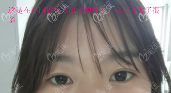 这是我在韩国做全切双眼皮的样子 这是我在韩国做全切双眼皮的样子