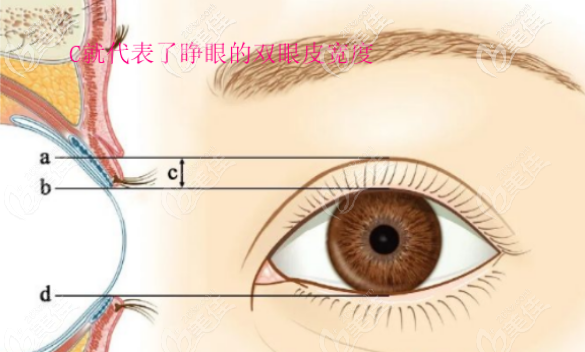 这是睁眼双眼皮的宽度图