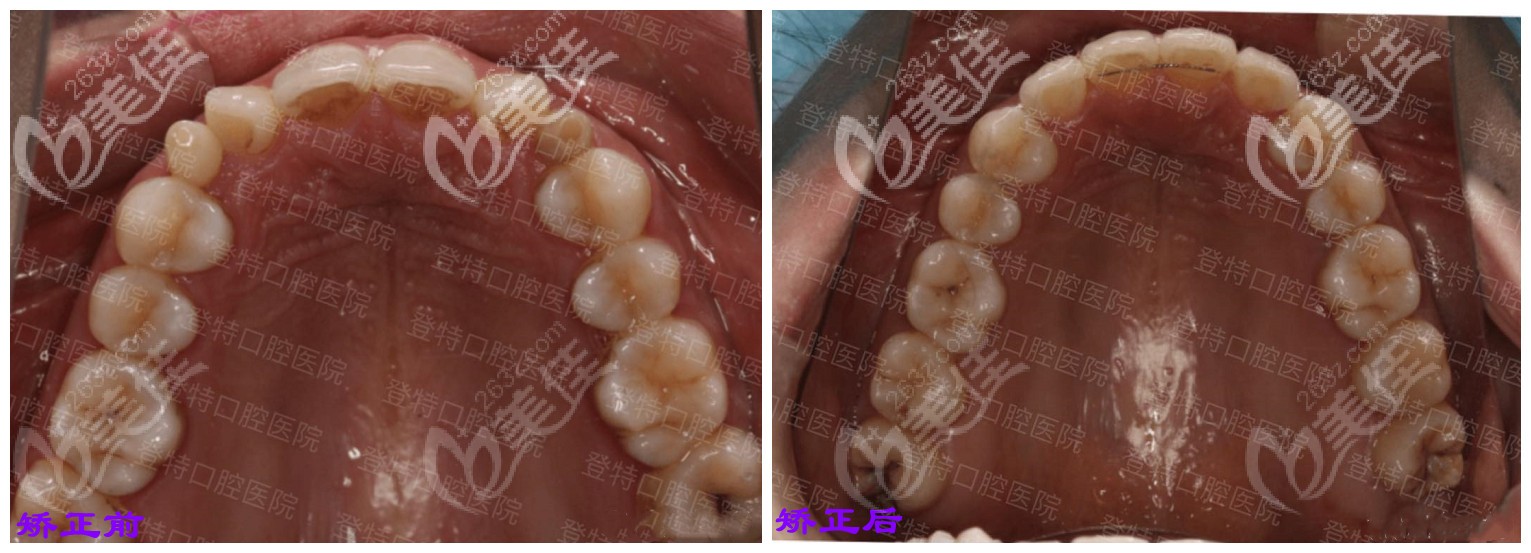 网友在福州登特矫正后的前后对比