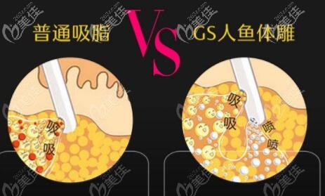 大连达美元辰GS人鱼体雕术吸脂