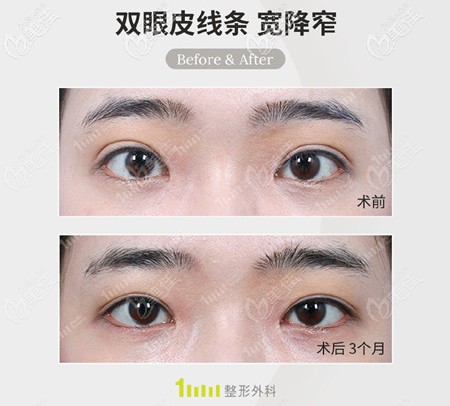 双眼皮肉条感明显修复成功案例