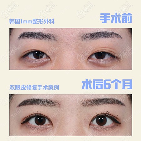 双眼皮修复后没复发案例