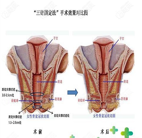 容脉新做埋线缩阴的优势 容脉新做埋线缩阴的优势