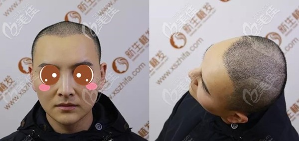 南京新生头顶加密植发手术