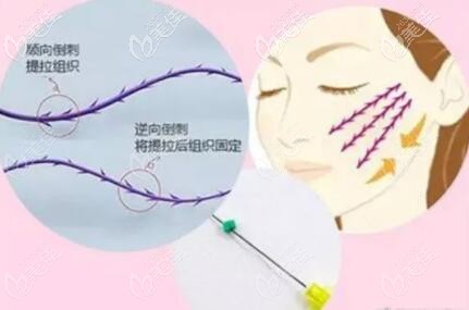 埋线提升线材展示