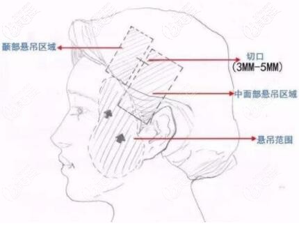 微创悬吊术的切口位置