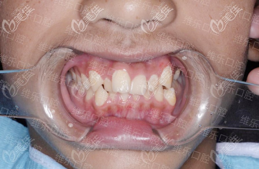 该男生牙齿矫正前效果