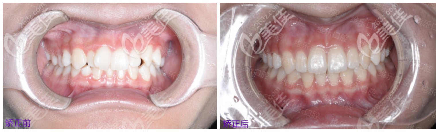 在泉州维乐矫正前后对比