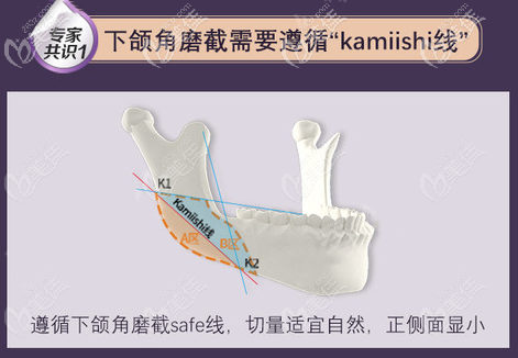 潘宝华下颌角磨骨技术特色