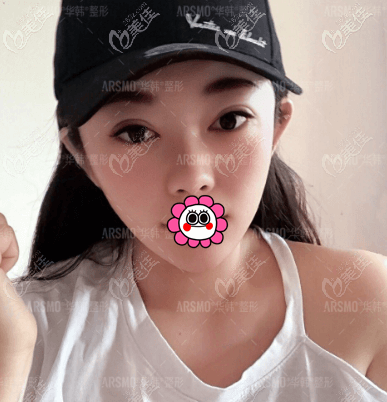 在北京华韩做欧洲之星Fotona 4D面部提拉10多天了 在北京华韩做欧洲之星Fotona 4D面部提拉10多天了