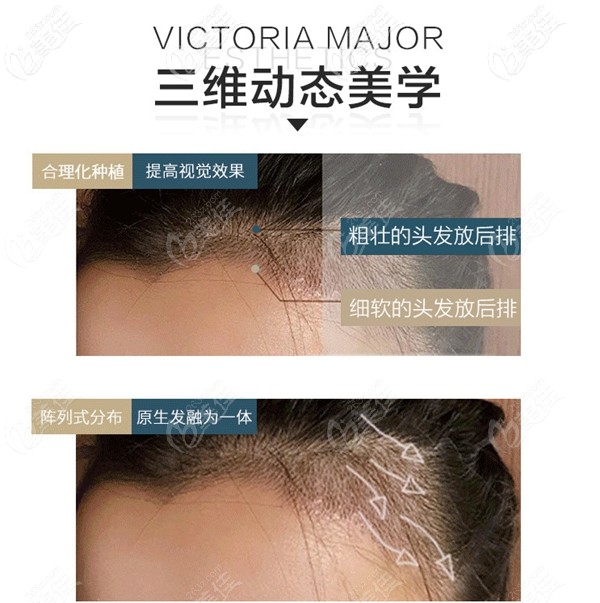维多利亚美学植发技术
