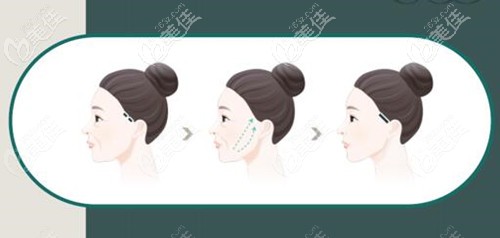 Elasticum弹力提升原理