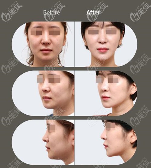 韩国原辰Elasticum弹力提升案例