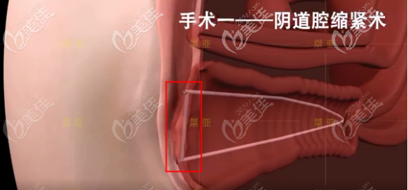 生物束带私密紧缩术之阴道腔紧缩术步骤三