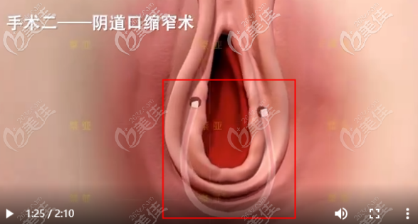 生物束带私密紧缩术之阴道口缩窄术步骤一