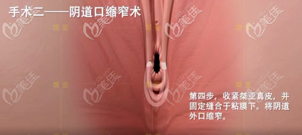 生物束带私密紧缩术之阴道口缩窄术步骤三