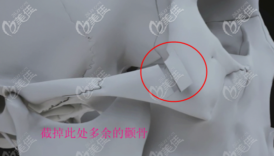 quick颧骨内推缩小手术操作示意图