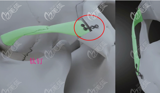 quick颧骨内推缩小手术操作示意图二