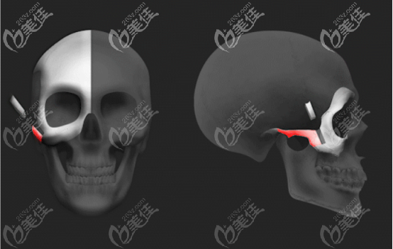 quick颧骨缩小手术的半折断优势一