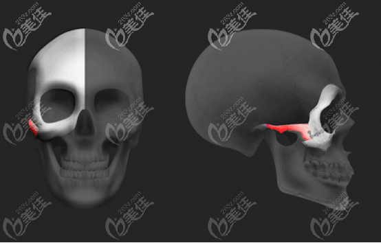 quick颧骨缩小手术的半折断优势二