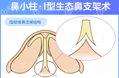 重庆时光I型肋骨鼻支架术