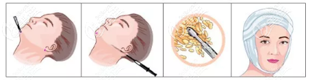 面部吸脂手术过程示意图