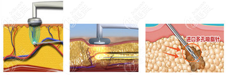 黄金微雕溶脂射频溶脂过程示意图