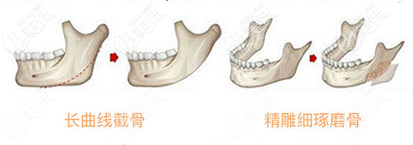李湘原下颌角磨骨