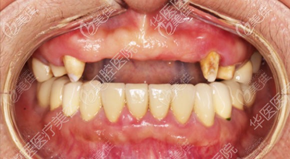 种植前的口内照 种植前的口内照