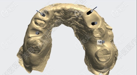 3D数字化导板电脑设计图 3D数字化导板电脑设计图