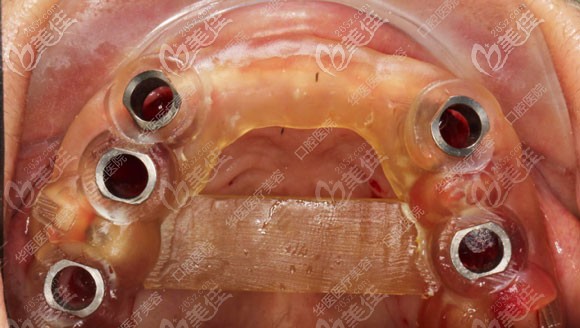 种植牙导板示意图 种植牙导板示意图