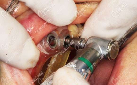 使用导板的种植过程 使用导板的种植过程