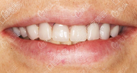 这是我们呼和浩特华医口腔做的上半口种植牙案例,给大家展示下怎么样