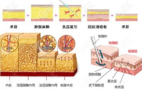 吸脂手术过程