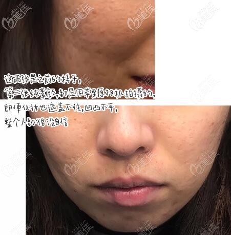 郴州曹家整形点阵激光祛痘坑治疗前图片 郴州曹家整形点阵激光祛痘坑治疗前图片