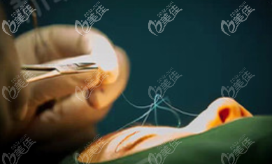 深圳富华整形段春巍医生双眼皮修复技术优势 深圳富华整形段春巍医生双眼皮修复技术优势