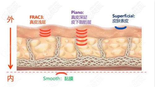 Fotona 4D Pro原理