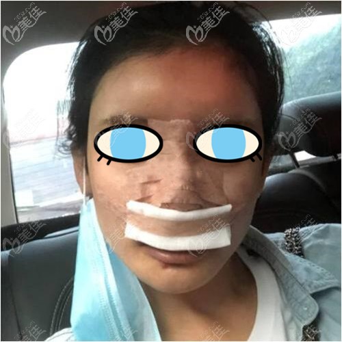 膨体隆鼻术后效果