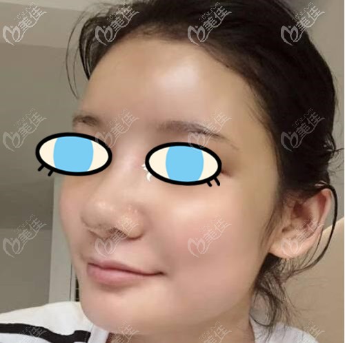 膨体隆鼻术后十天效果