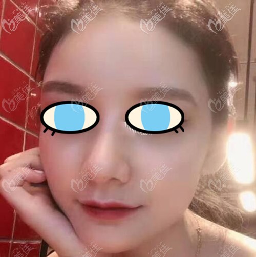 膨体隆鼻术后三个月效果