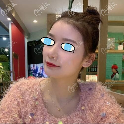 南宁梦想膨体隆鼻后期效果:术前的鼻梁塌陷不见了,只留下挺翘立体