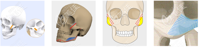 邱立东颧骨三体复合缩小手术过程示意图