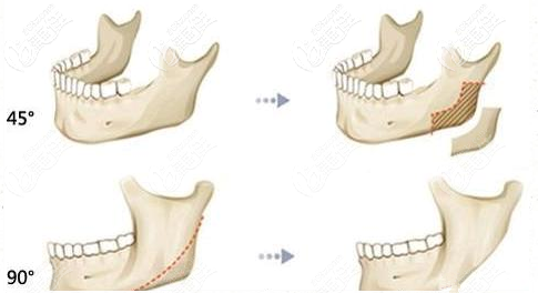 <!--<i data=20240703-sp></i>-->下颌角手术哪家好？参考<!--<i data=20240703-sp></i>-->下颌角磨骨人气医生技术