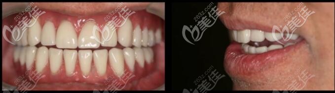 下颌半口马龙桥修复效果图