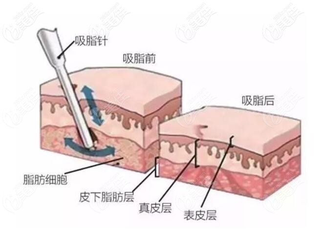 李宰荣院长吸脂特点