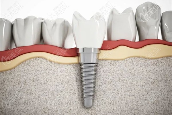 听说在呼市华医口腔医院做一颗种植牙才4999元,还附送德国威兰德全瓷牙冠呢